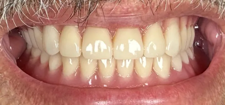 After: the same actual patient after full-mouth dental implants by Dr. Adrian Franco. Individual results may vary.