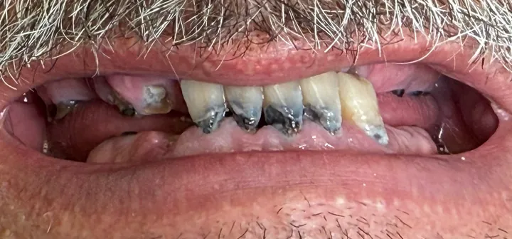 Before: an actual patient of Dr. Adrian Franco, before full-mouth dental implants.