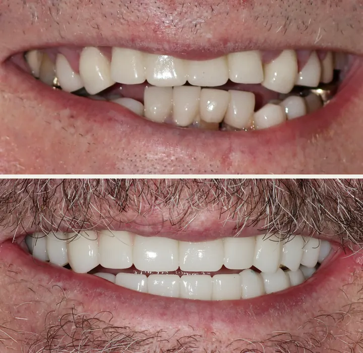 Before: an actual patient of Dr. Adrian Franco, before full-mouth All-on-X dental implants.